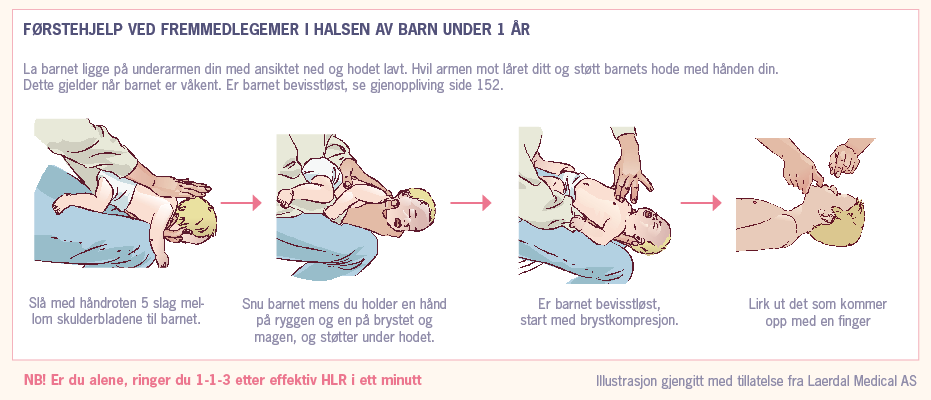 Førstehjelp ved fremmedlegemer i halsen