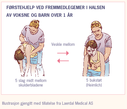 Førstehjelp fremmedlegemer i halsen barn over 1 år og voksne