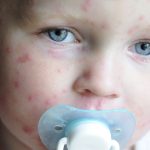 Chicken pox