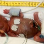 Prematur_baby