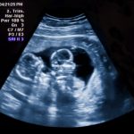 twins-ultrasound-picture-id506063233