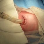 gastroschise_lukket980-4