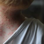 Chicken pox