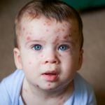 young-toddler-with-chickenpox-picture-id1068794940