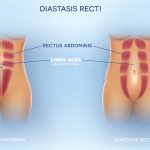 Diastasis Recti