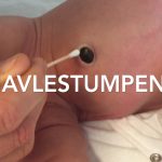 Navlestumpen – slik gjør du