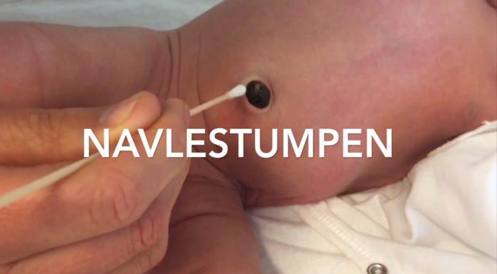 Navlestumpen – slik gjør du