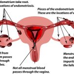 endometrioseforklaring-3