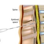 epidural-administration-or-epidural-anesthesia-tuohy-epidural-needle-vector-id1290097842