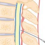 epiduralillustrasjon-6